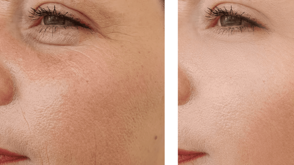 Couperose, érythrose et acné rosacée, comment fait-on pour s’en débarrasser