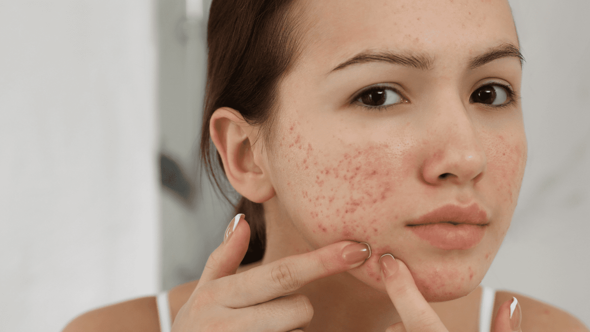 L'histamine peut-elle déclencher la rosacée?